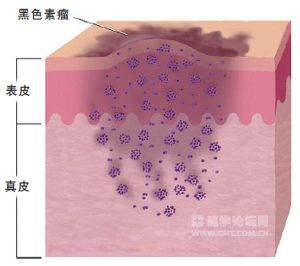 黑色素瘤如何治疗